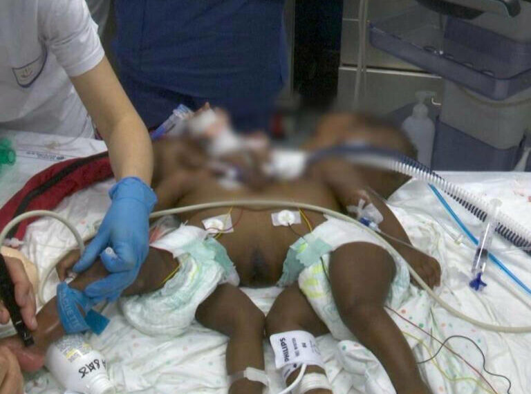 Operate le due gemelle siamesi e unite nella regione toracica e addominale